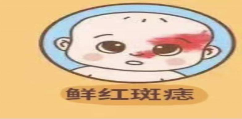 染料激光治疗原理