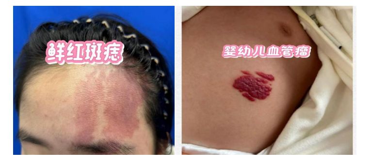染料激光治疗原理