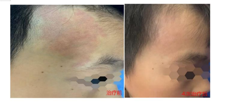 染料激光治疗原理