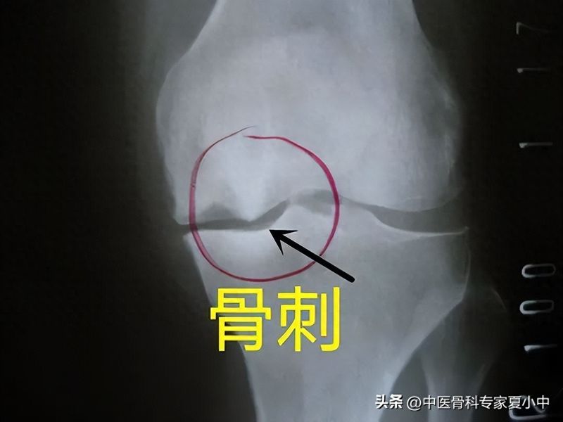 足跟骨刺的治疗方法