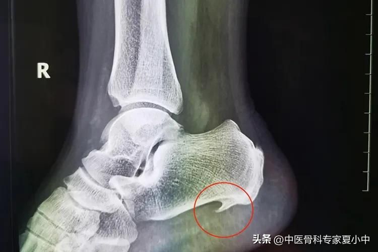 足跟骨刺的治疗方法