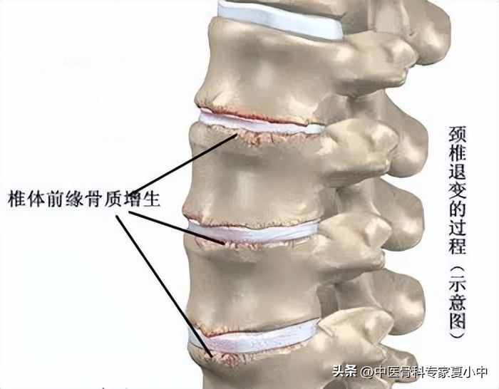 足跟骨刺的治疗方法
