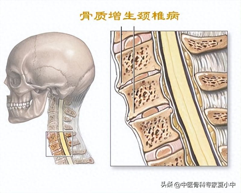 足跟骨刺的治疗方法