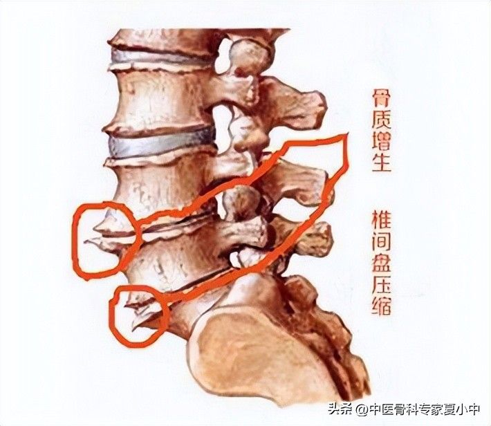 足跟骨刺的治疗方法
