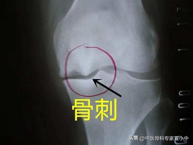 足跟骨刺的治疗方法