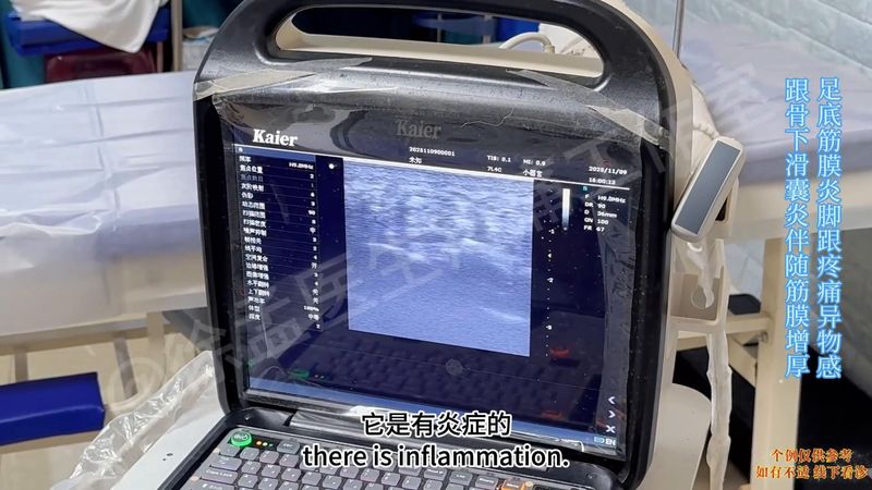足跟骨刺的治疗方法