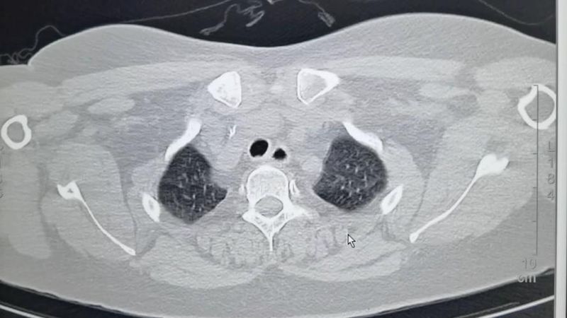 山西省生医院拍个胸片多少钱