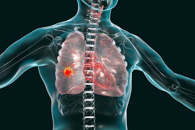 Phenopathology of lung cancer