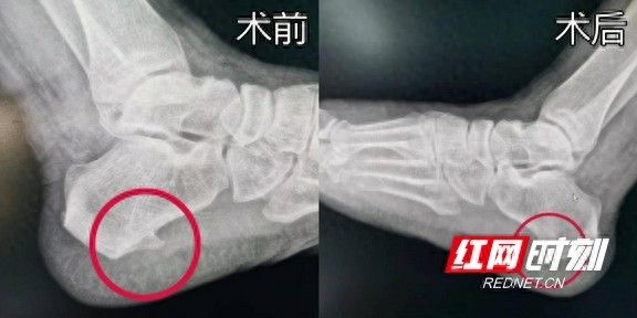 足跟骨刺的治疗方法