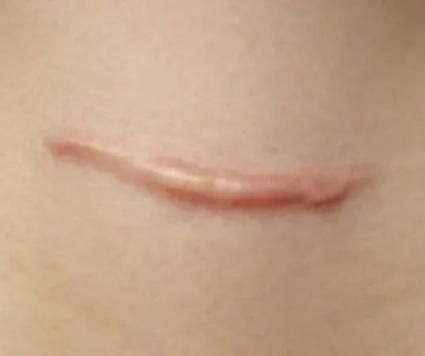 疤痕美白知识介绍