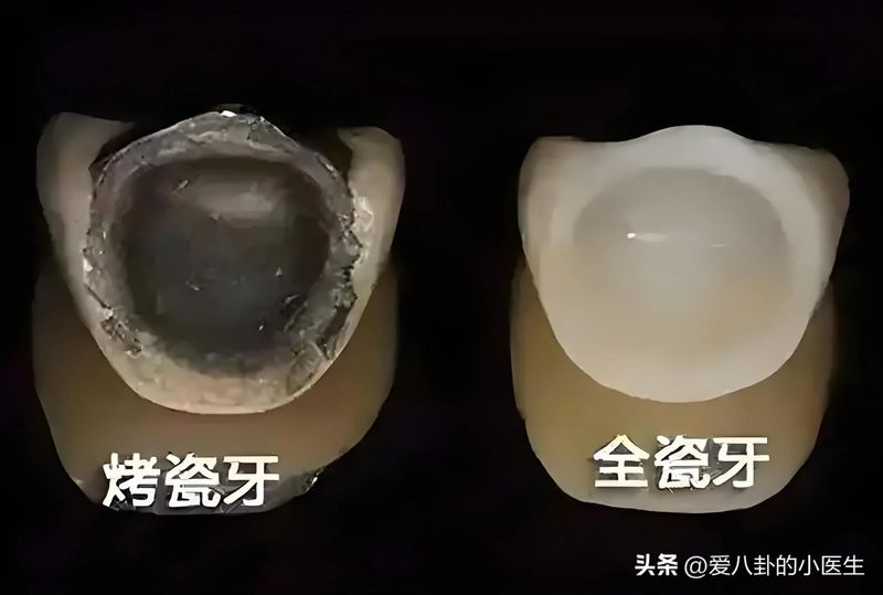 淄博镍铬烤瓷牙多少钱