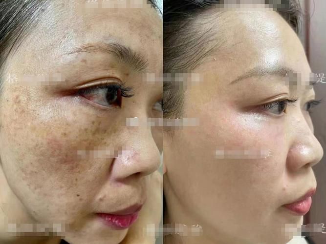 黄褐斑的治疗方法