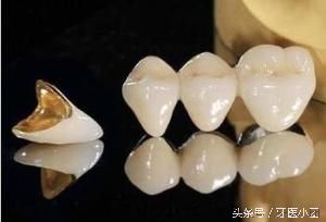 淄博镍铬烤瓷牙多少钱