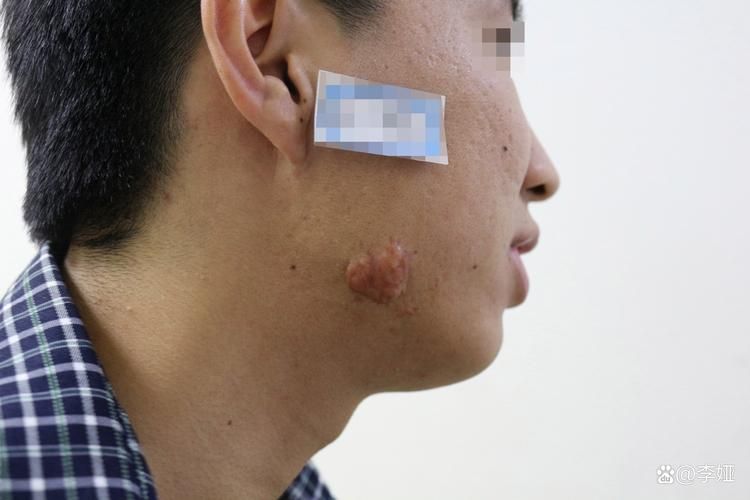 疤痕美白知识介绍
