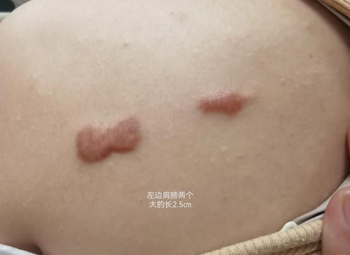 疤痕美白知识介绍