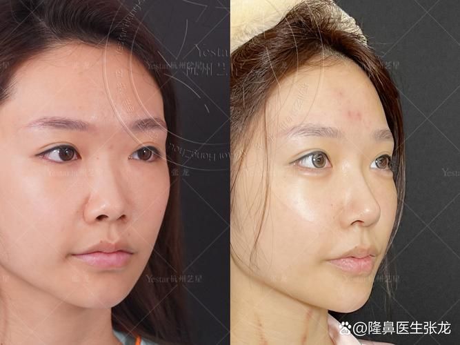 北京硅胶隆鼻原理