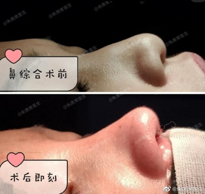 北京硅胶隆鼻原理