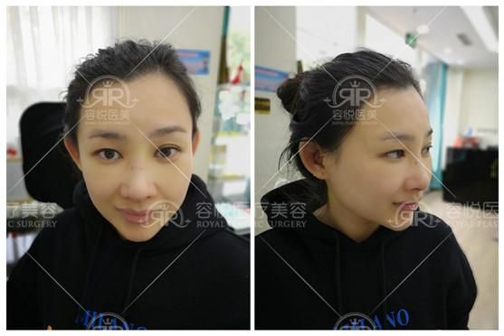 北京硅胶隆鼻原理