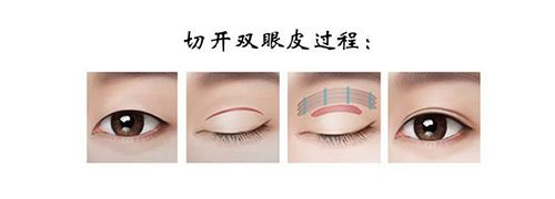 大连缝双眼皮多少钱