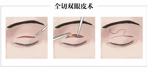 大连缝双眼皮多少钱