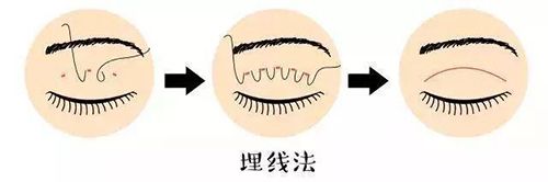 大连缝双眼皮多少钱