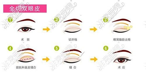 大连缝双眼皮多少钱