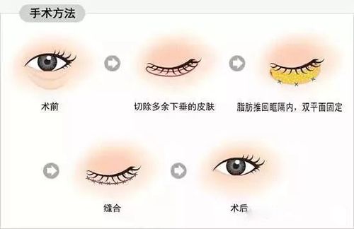 大连缝双眼皮多少钱
