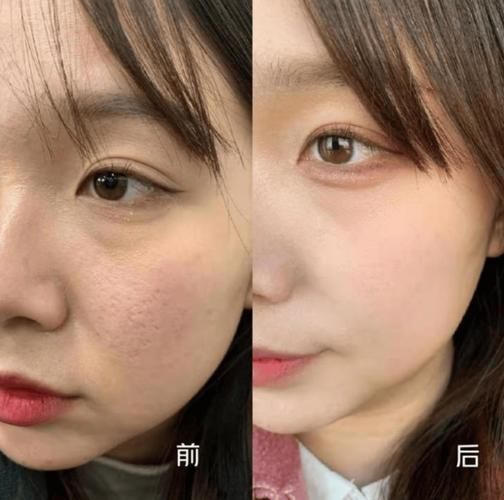 脸部光子嫩肤多少钱