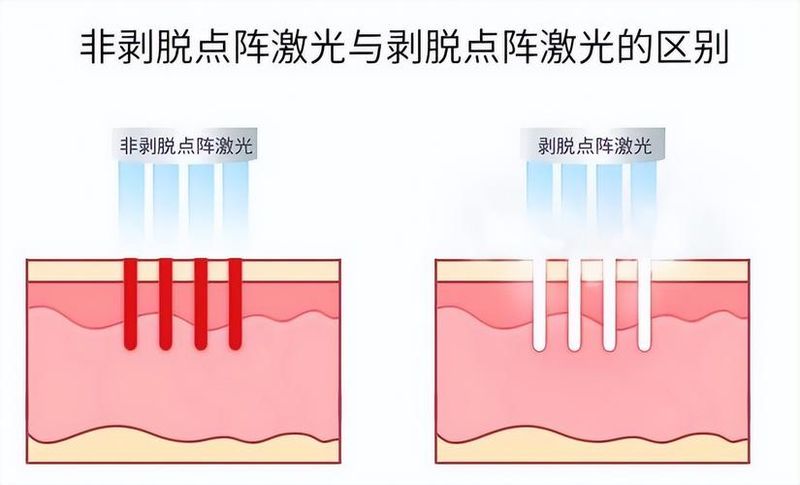 脸部光子嫩肤多少钱