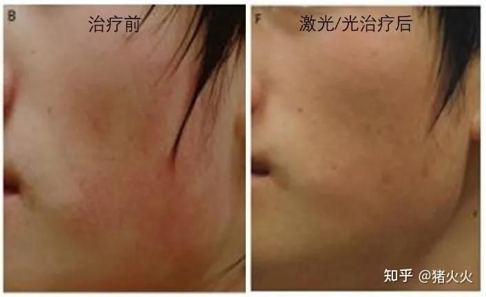 脸部光子嫩肤多少钱