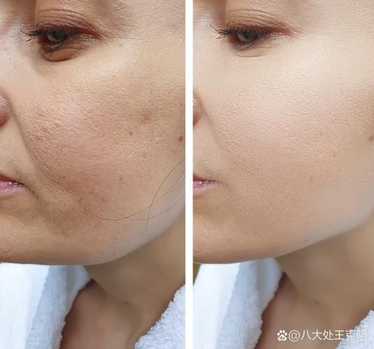 脸部光子嫩肤多少钱