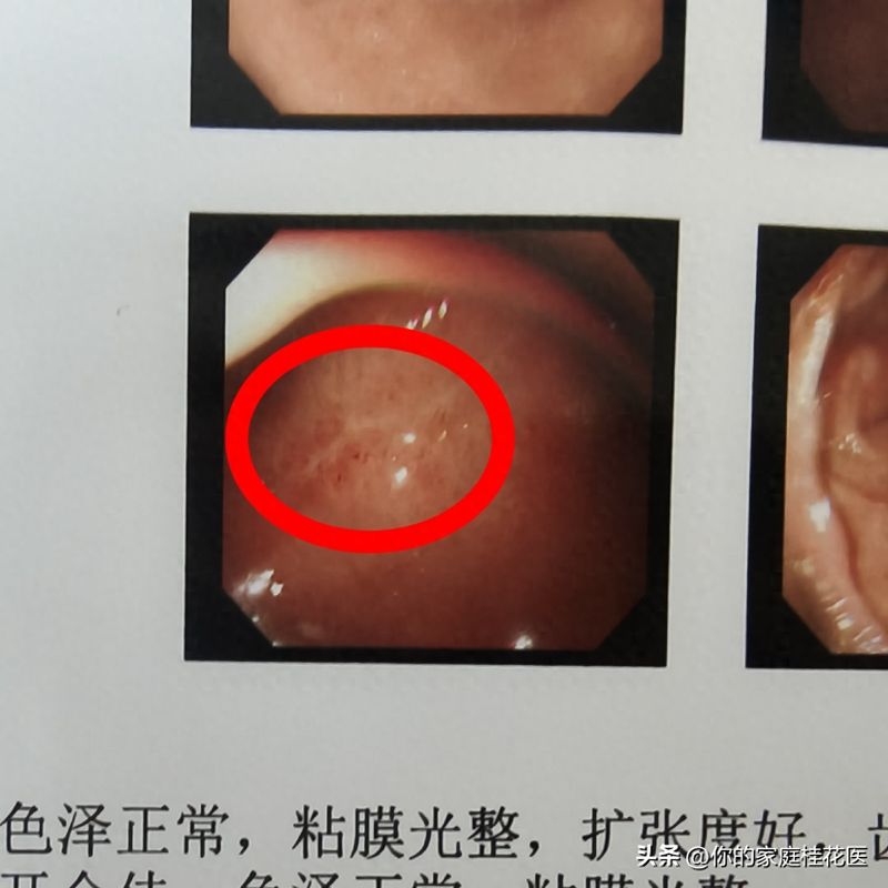 十二指肠球部溃疡的治疗方法