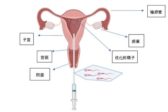人工授精术费用