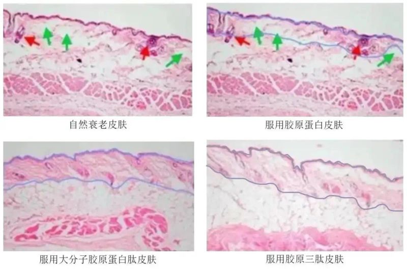 胶原蛋白注射隆鼻多少钱