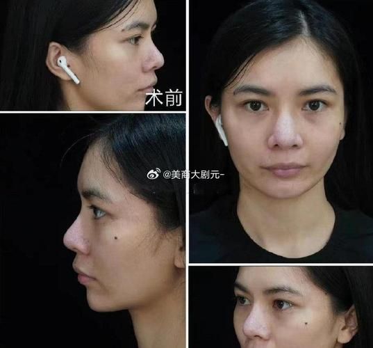 隆鼻大概多少钱