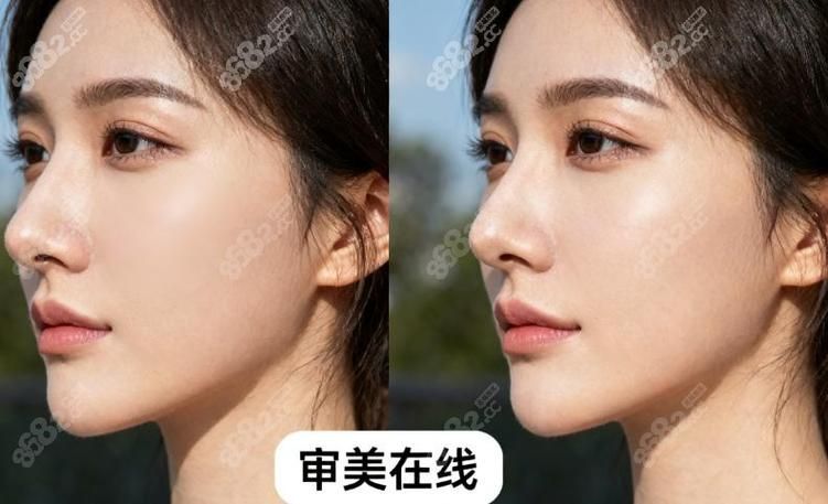 隆鼻大概多少钱