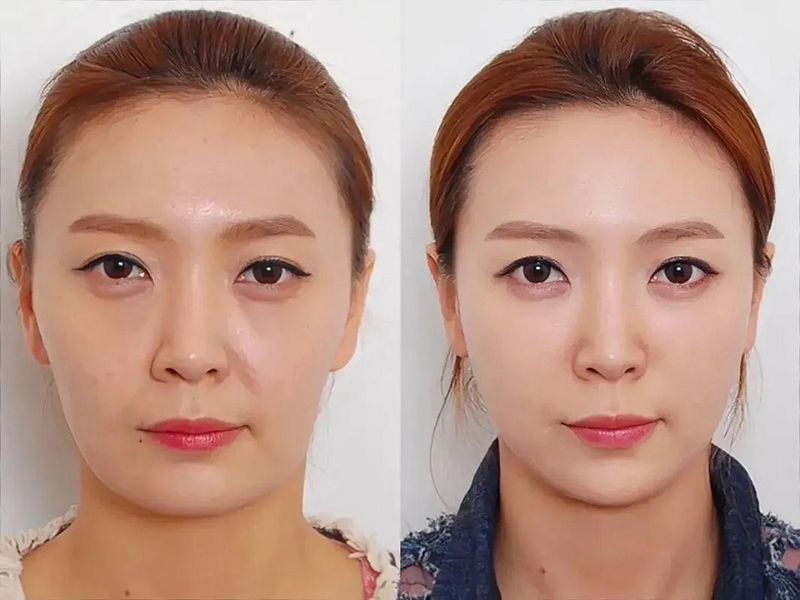 面部脱毛方法