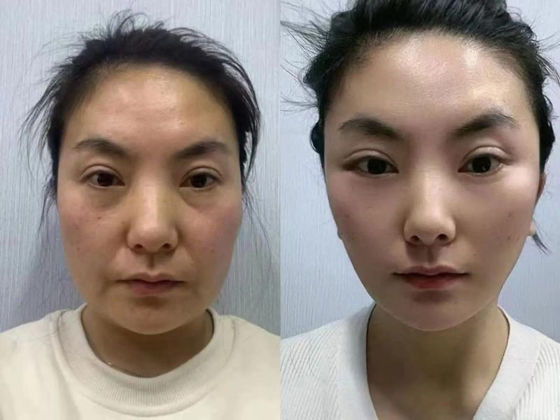 面部脱毛方法