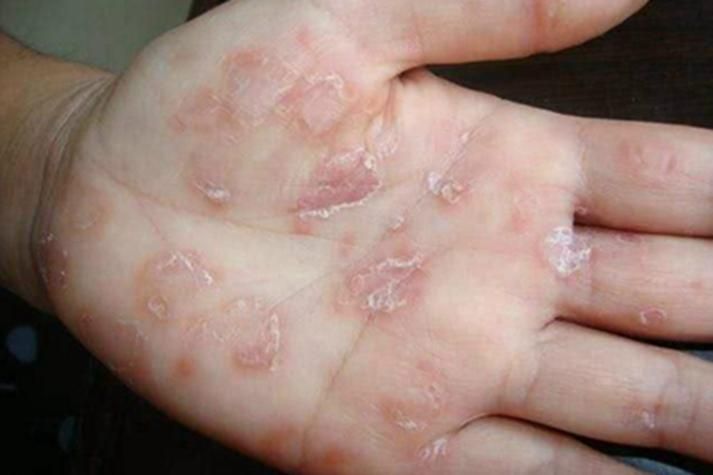 手脚癣的治疗方法