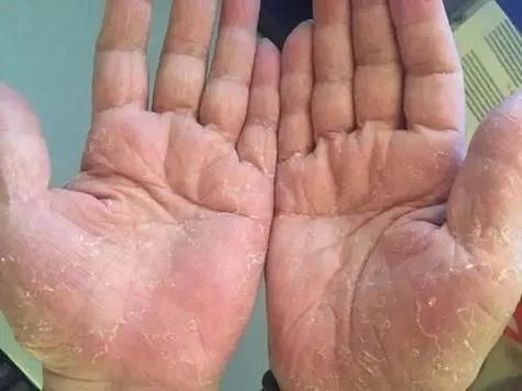 手脚癣的治疗方法