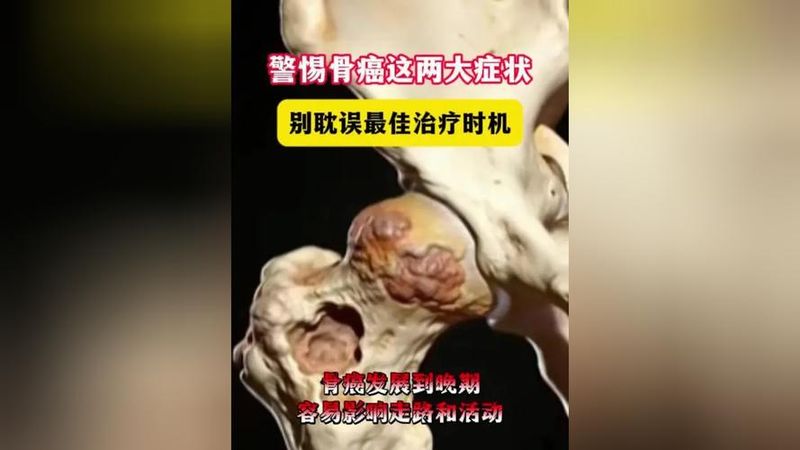 Treatment for bone cancer
