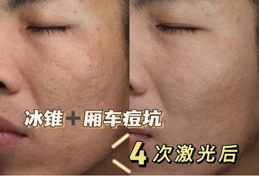 柳州激光去痘多少钱