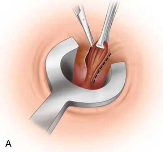 How much for mixed hemorrhoid surgery