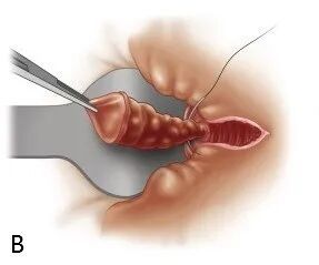 How much for mixed hemorrhoid surgery