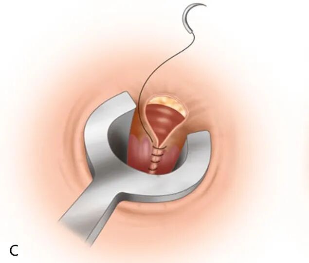 How much for mixed hemorrhoid surgery