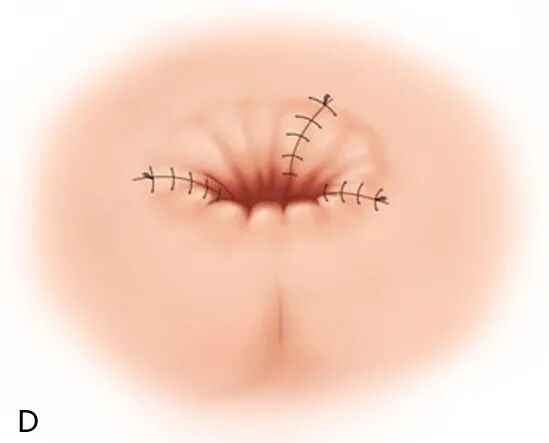 How much for mixed hemorrhoid surgery