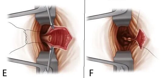How much for mixed hemorrhoid surgery