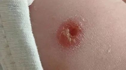 预防接种知识问答