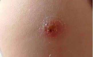 预防接种知识问答