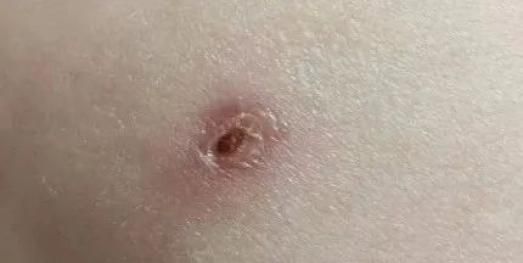 预防接种知识问答
